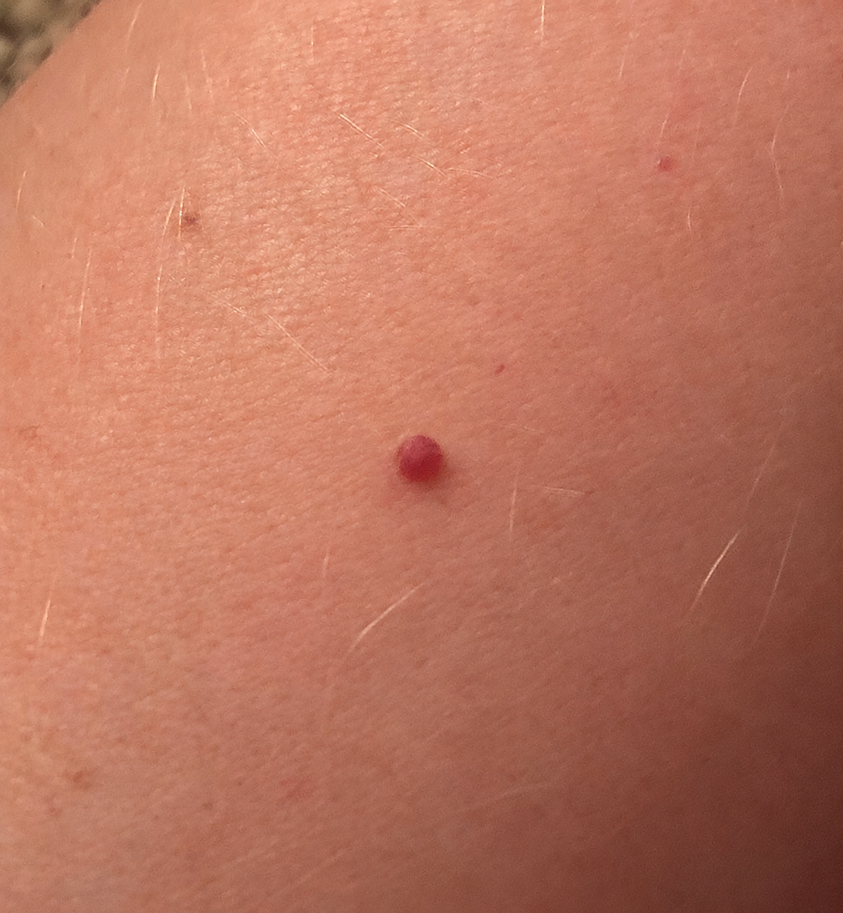 Example of a cherry angioma