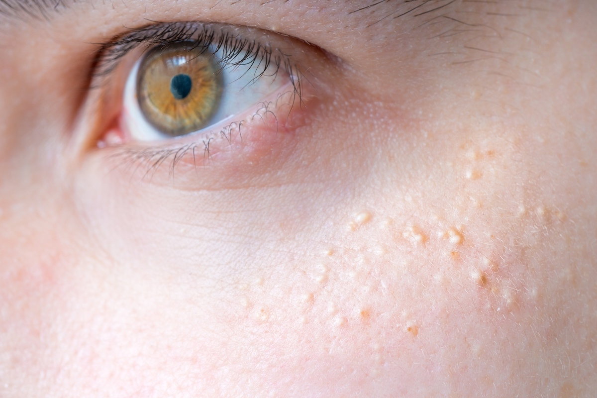 Example of small white milia bumps on the cheek
