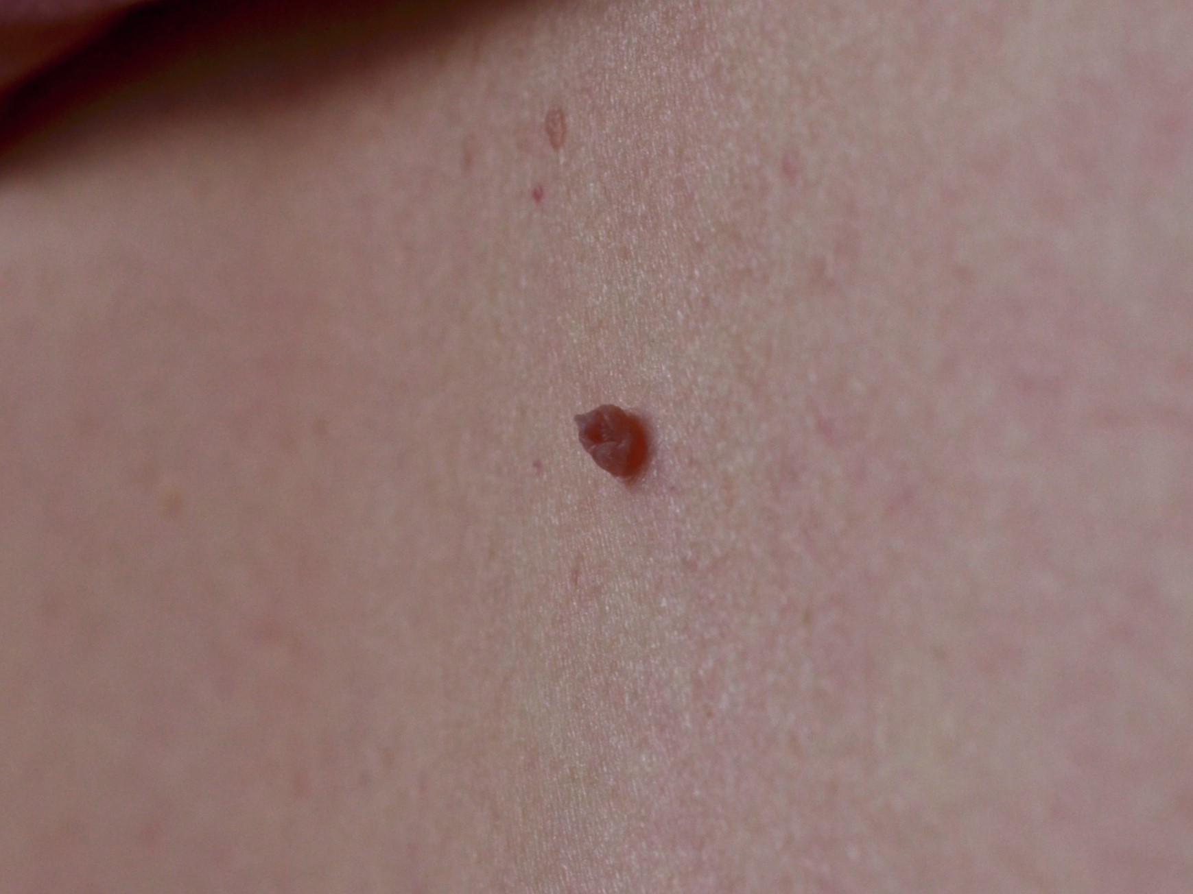 Close-up example of a skin tag